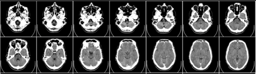 Intervention for OCD obsessive-conpulssive disorder